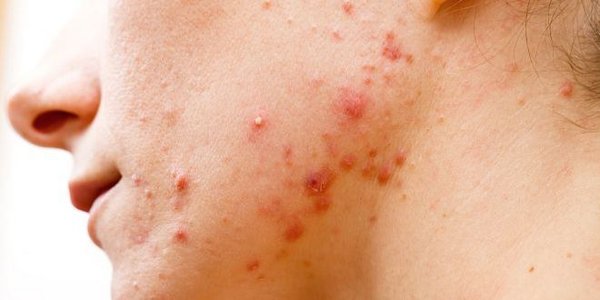 Impetigo contagiosa