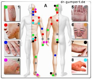 Abbildung Hautausschlag mit roten Flecken