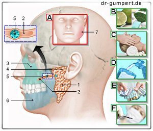 Abbildung Entzündung der Ohrspeicheldrüse