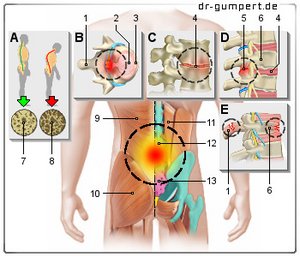 Abbildung Rückenschmerzen unterer Rücken