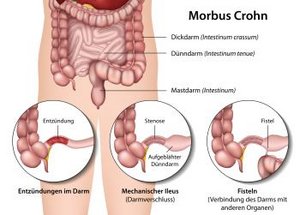 Schub eines Morbus Crohn