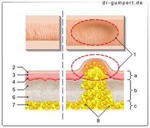 Abbildung Lipom