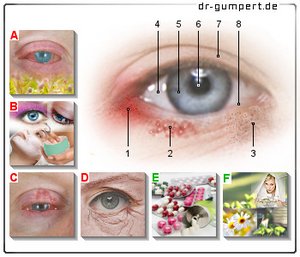 Ausschlag unterm auge