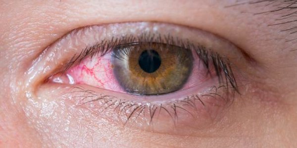 Ader Geplatzt Im Auge Ursache www.dr-gumpert.de