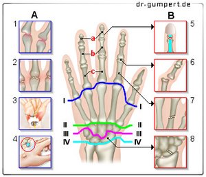 Abbildung Schmerzen Hand