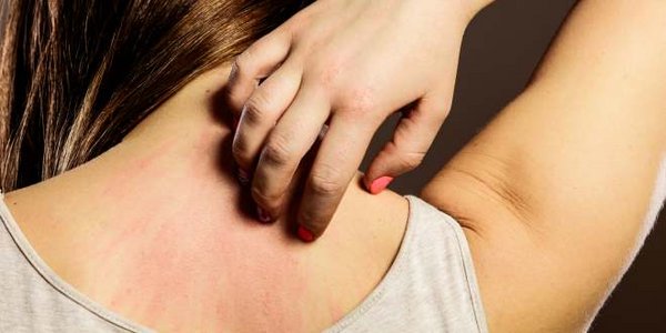 Hautausschlag im Nacken