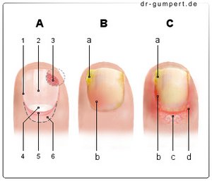 Operation nagelbettentzündung zeh Nagelbettentzündung: Symptome