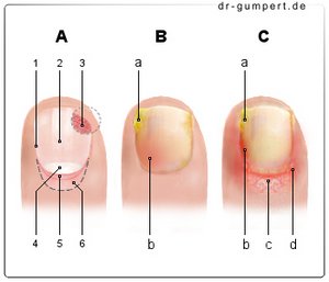 Abbildung Nagelbettentzündung
