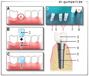 Abbildung Zahnimplantat