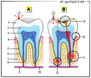 Abbildung über die Ursachen einer Zahnwurzelentzündung