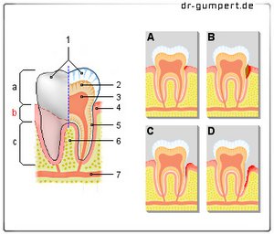 Abbildung Schmerzen am Zahnhals