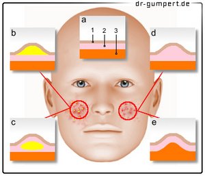 Abbildung Hautausschlag Gesicht
