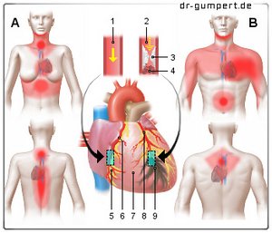 Abbildung Herzinfarkt
