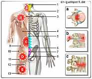 Abbildung Rückenschmerzen