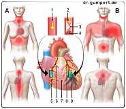 Abbildung Herzinfarkt