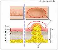 Abbildung Lipom