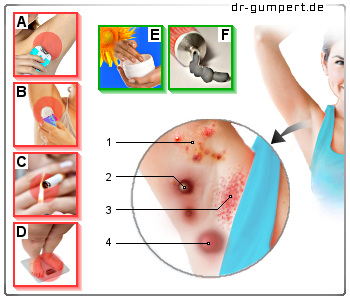 Schematische Darstellung einer Achselhöhlenentzündung