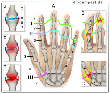 Schematische Darstellung einer Fingerarthrose