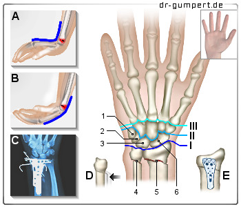 Schematische Darstellung eines Handgelenksbruchs