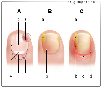 Schematische Darstellung einer Nagelbettentzündung