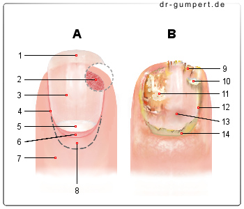 Schematische Darstellung eines Nagelpilzes