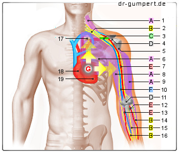 Schematische Darstellung zu Schmerzen im linken Arm