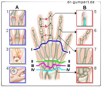 Schematische Darstellung von Handgelenksschmerzen