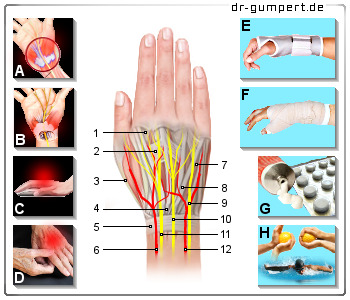 Schematische Darstellung zu Schmerzen am Handrücken