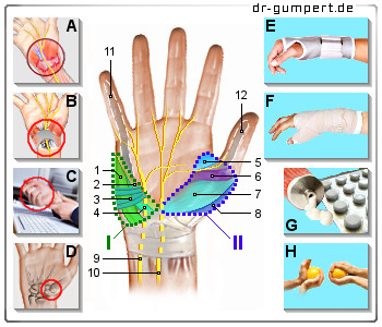 Schematische Darstellung zu Schmerzen am Handballen