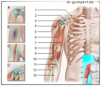 Schematische Darstellung zu Schmerzen im Oberarm
