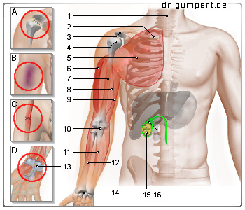 Schematische Darstellung zu Schmerzen am rechten Arm