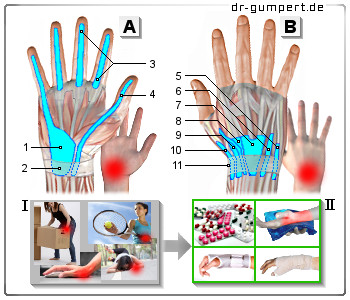 Schematische Darstellung Sehnenscheidenentzündung am Handgelenk