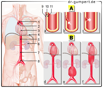 Schematische Darstellung des Aortenrisses