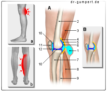 Schematische Darstellung einer Baker-Zyste