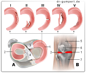 Schematische Darstellung eines Meniskusrisses