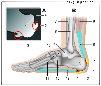 Schematische Darstellung eines Fersensporns