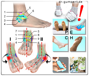 Schematische Darstellung eines umgeknickten Fußes