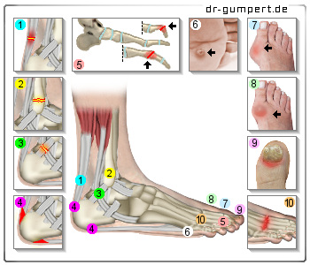 Schematische Darstellung von Fußschmerzen
