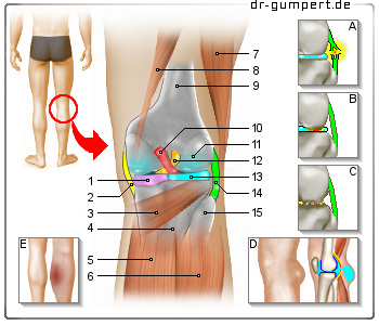 Schematische Darstellung von Kniekehlenschmerzen