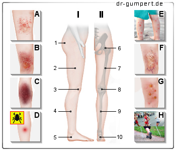 Schematische Darstellung Rote Flecken an den Beinen