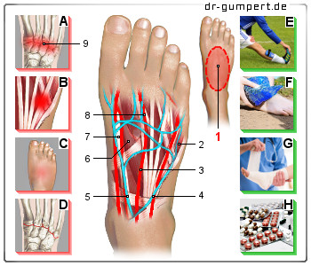 Schematische Darstellung zu Schmerzen am Fußspann