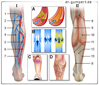 Schematische Darstellung Schmerzen an der Wade