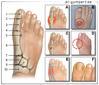 Schematische Darstellung zu Schmerzen im großen Zeh