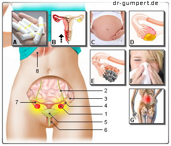 Schematische Darstellung von Schmerzen in den Eierstöcken