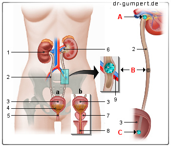 Schematische Darstellung von Harnleitersteinen