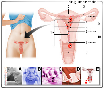 Schematische Darstellung Polypen der Gebärmutter