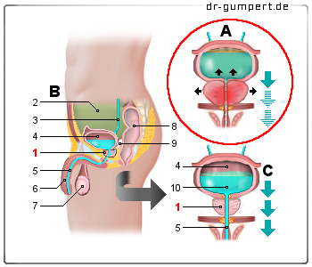 Schematische Darstellung einer Prostatavergrößerung