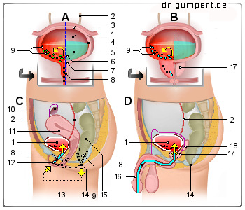 Schematische Darstellung zu Schmerzen beim Wasserlassen