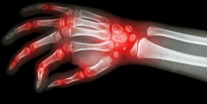 Rheumatoide Arthritis Ursachen