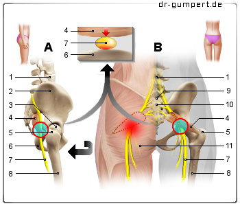 Schematische Darstellung des Piriformis-Syndroms